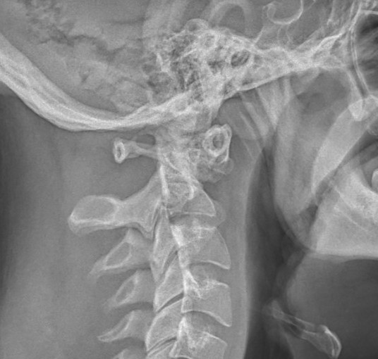 Atlantoaxial instability The Bone School
